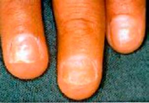 moisture levels allow it to grow. The after effects of this infection will cause the nail plate to darken and soften underneath an artificial coating.