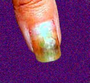 A fungal or yeast infection which results in Onychomycosis, can invade through a tear in the proximal and lateral nail folds as well as the eponychium.