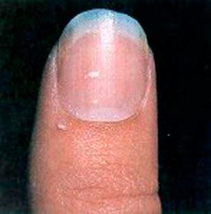 As the infection progresses, organic debris accumulates under the nail plate often discoloring it.