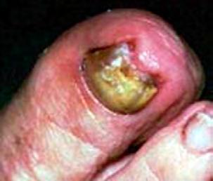 Tinea Unguis, or ringworm of the nails, is characterized by nail thickening, deformity, and eventually results in nail plate loss.