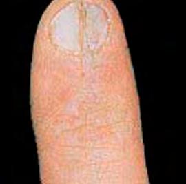 Injury or disease may account for this irregularity. Onychorrhexis are brittle nails which often split vertically, peel and/or have vertical ridges.