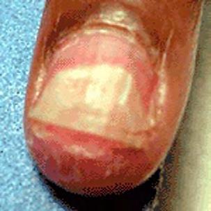 these nails show raised ridges and are thin and concave. Seek a physicians advice and treatment.