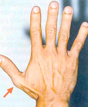 Yellow nail syndrome Yellow nail syndrome is characterized by yellow nails that lack a cuticle, grow slowly, and are loose or detached (onycholysis).
