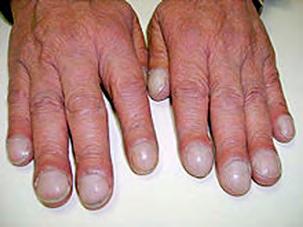 Clubbing In medicine, nail clubbing (also known as "Drumstick fingers," "Hippocratic fingers," and "Watch-glass nails") is a deformity of the fingers and fingernails