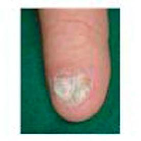 phenomenon is therefore occasionally called Hippocratic fingers. Idiopathic clubbing can also occur and in 60% of cases there is no associated underlying disease.