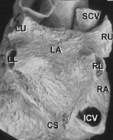 LA & PULMONARY VEINS The pulmonary veins (PV) in the human heart enter the LA