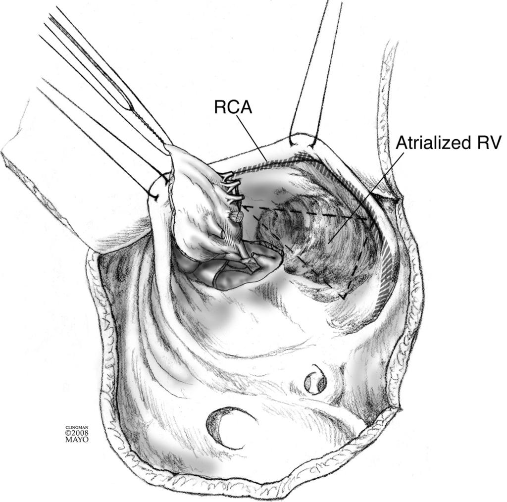 118 J.A. Dearani, E. Bacha, and J.P. da Silva Figure 9 After the cone reconstruction is completed, the atrialized right ventricle (RV) is examined to determine if plication is necessary.