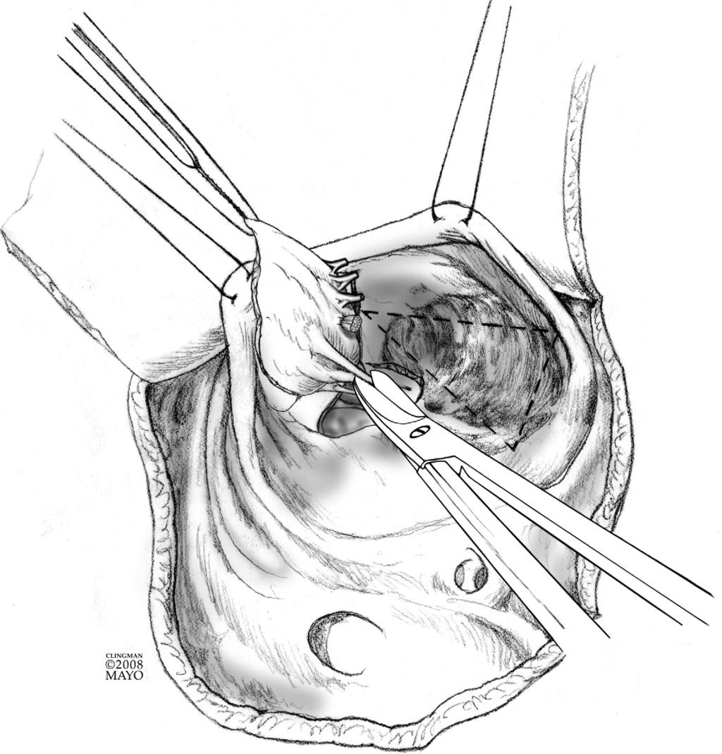 Cone reconstruction of the tricuspid valve for Ebstein s anomaly 113 Figure 4 As the anterior and surgically delaminated inferior leaflet is reflected away from the right ventricular myocardium, all