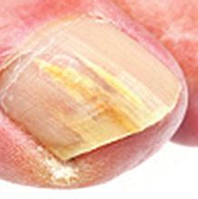 Toenail fungus is an infection that lives underneath the nail, in the skin of the nail bed. Toenail fungus is more than a cosmetic concern. Recurrence is common.