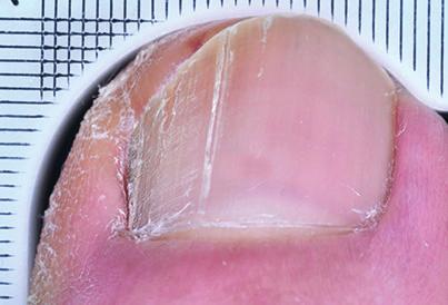 17% of patients had completely clear nails Complete Cure: No fungus present and 0% visible toenail impairment Baseline BEFORE Week 52 AFTER 25% of patients had clear or mostly
