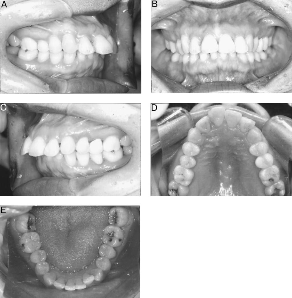 STATICALLY DETERMINATE RETRACTION SYSTEM 195 FIGURE 7. Pretreatment state of occlusion. The patient had procumbent anterior teeth and Class II molars with a severe curve of Spee. dimension.