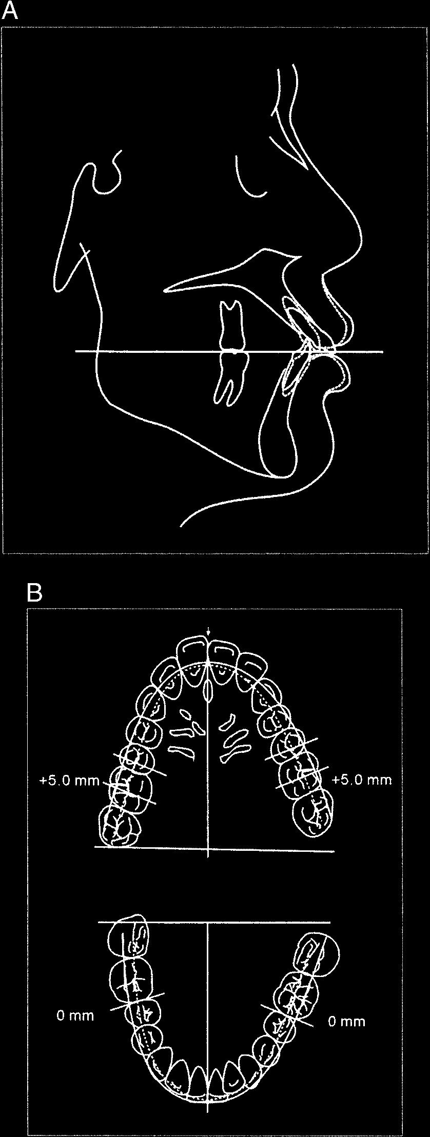 196 CHOY, PAE, KIM, PARK, BURSTONE FIGURE 9. (A) Before intrusion. (B) After intrusion. Intrusion was performed along the long axis of the anterior teeth to the same level of the canine.