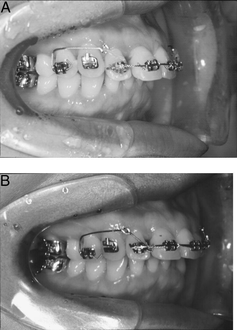 A significant retraction of the upper anterior segment and an intrusion of the lower incisors were planned after two upper first bicuspid extractions.