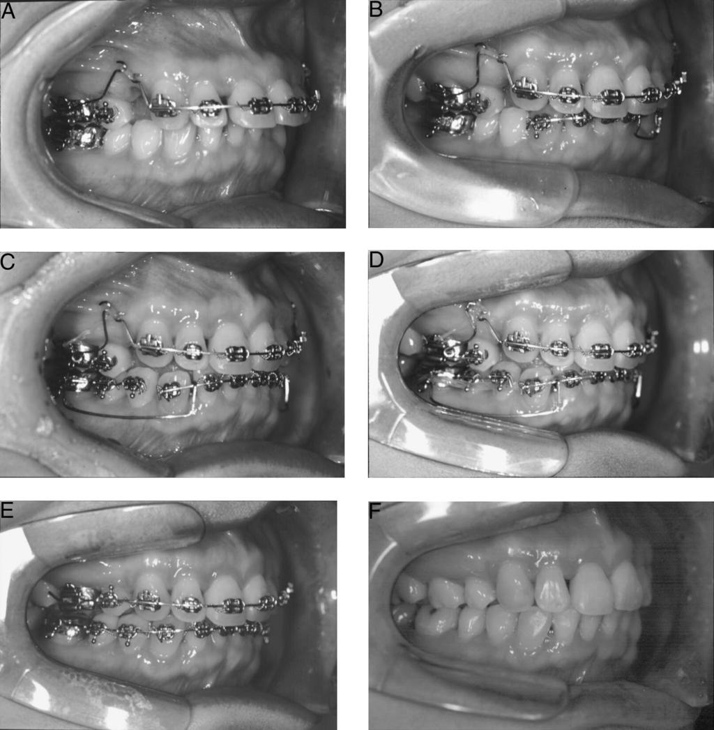 STATICALLY DETERMINATE RETRACTION SYSTEM 197 FIGURE 10. Retraction of the anterior teeth with the statically determinate retraction system.