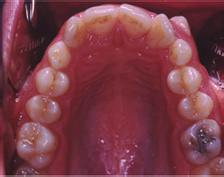 appliance, management of the space for impacted and ectopic teeth by coil springs, surgical exposure,