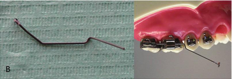 J Wilcock Australian wire (regular+, G&H Orthodontics, Franklin, IN, USA).