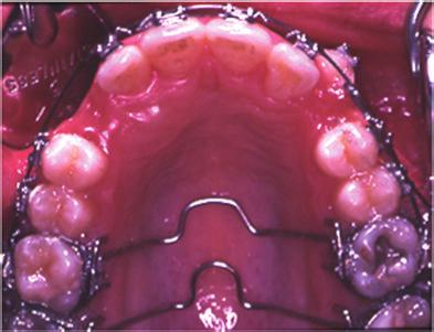Case Reports in Dentistry 5 Figure 6: From left to right,