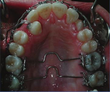 A lingual sheath was bonded using the same procedure