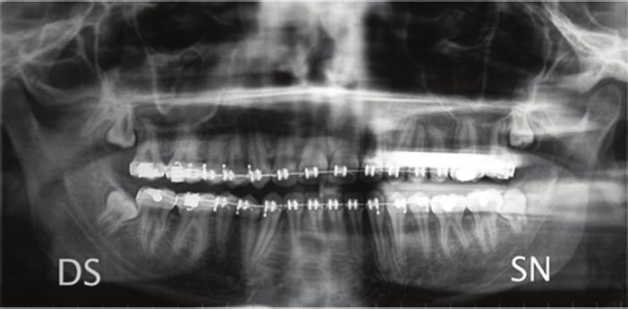Case Reports in Dentistry 7 52 87 30 91 92 57 33 48 15 124 29 2 5 3 4 19 Figure 9: Panoramic and lateral radiographs with cephalometric tracing before debonding at the end of treatment.