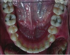 maintain lower incisor alignment.