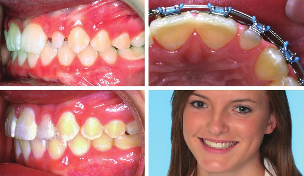 Conversely, in cases where the upper teeth are too narrow or the lower teeth are too wide, the orthodontist can establish an occlusion with smaller overjet and/or overbite, less inclination of lower