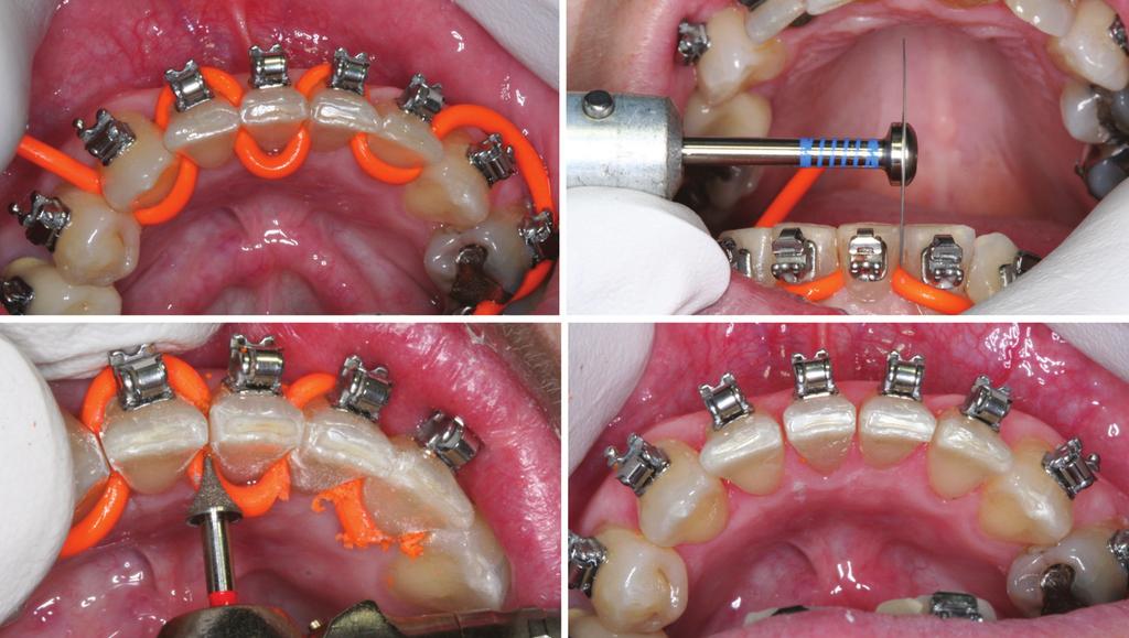 C D FIGURE 5. Reduction approach: clinical sequence of interproximal reduction., Teeth are separated and gingival tissues are protected with WedJet (Coltène Whaledent, lstatten, Switzerland).