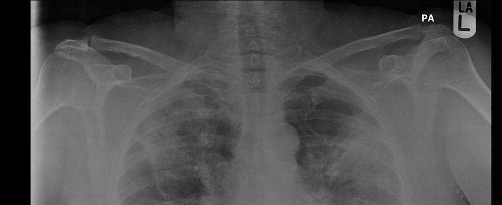 Chest radiograph on