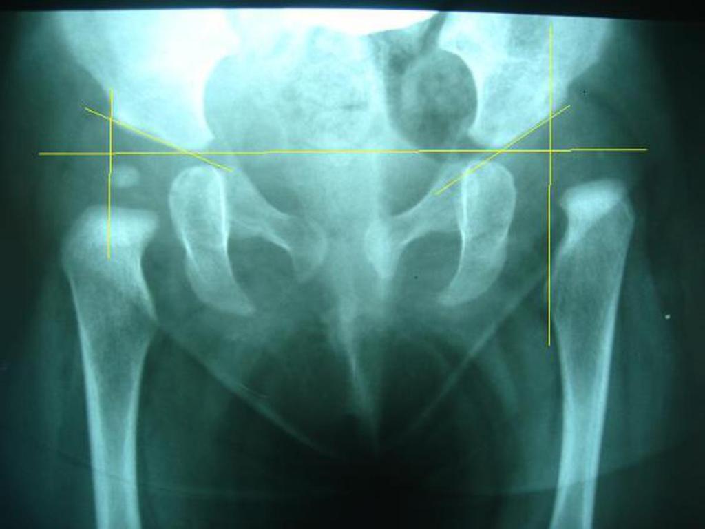 Fig. 13: Left side hip
