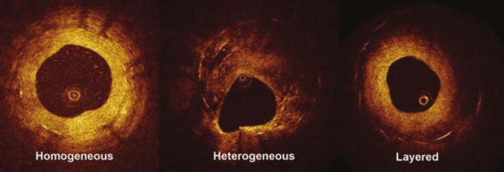 Drug eluting stent restenosis: an emerging challenge / Populations at risk after myocardial infarction: gender, age and lifestyle 463 the cases. The mean restenotic tissue symmetry ratio was 0.58±0.