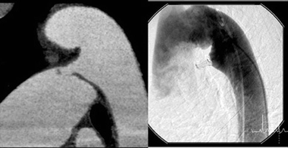490 Novel techniques: computed tomography and cardiovascular magnetic resonance / Monitoring and analysis clusters. A control group (21p) with a BHR<65 bpm did not need any drug.