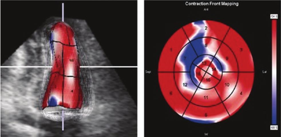 Echocardiography in cardiomyopathy 345 twist from 4.5±3 to 5.5±3.2 (p=0.003).