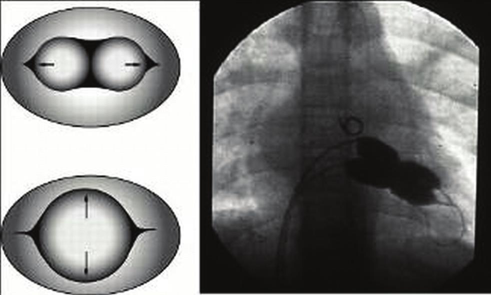392 Non-coronary cardiac interventions P2351 Clinical results of large secundum atrial septal defect closure in adult using percutaneous cocoon atrial septal occluder K. Lairakdomrong, S.