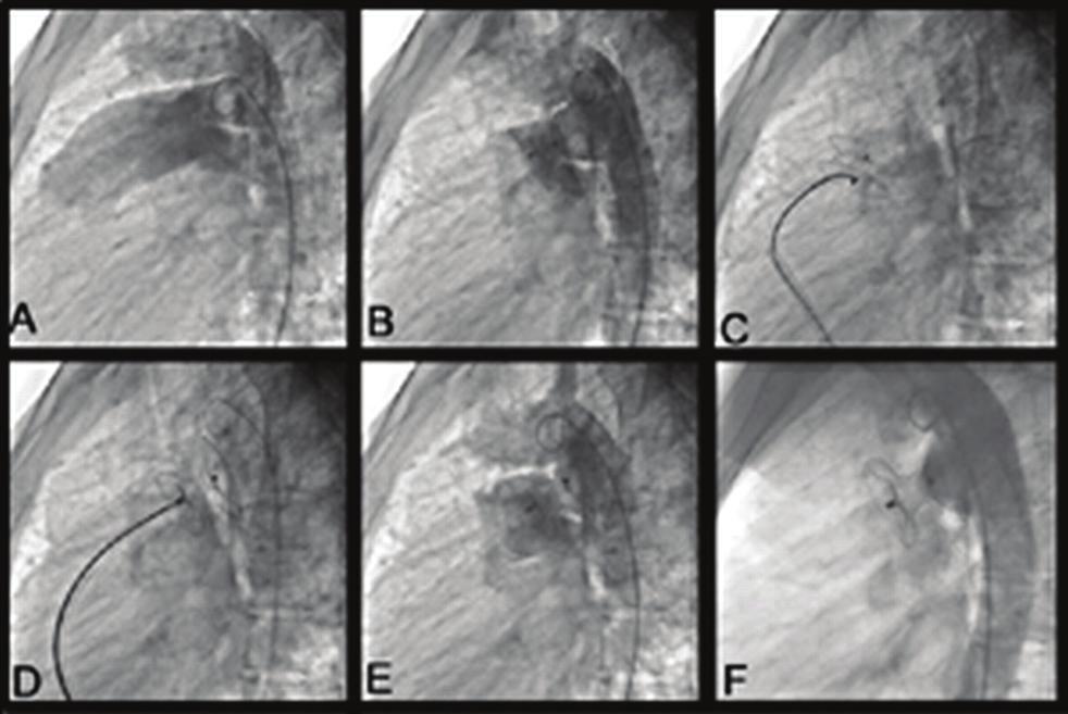 Imaging and intervention in congenital heart disease 397 P2372 Transcatheter closure of the patent ductus arteriosus using the amplatzer duct occluder in symptomatic infants with low weight F.