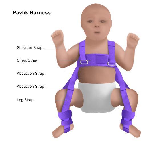 Illustration of infant wearing a Pavlik harness The information on this Web page is provided for educational purposes.