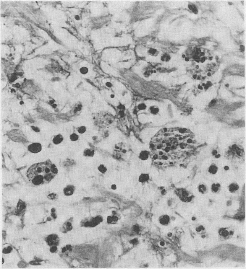 Sweet's syndrome *fi V,< ' A4: ~ ~ Fig 3 Case 2: neutrophil nuclear debris ingested by macrophages. (Haematoxylin and eosin.) x 500. patients.