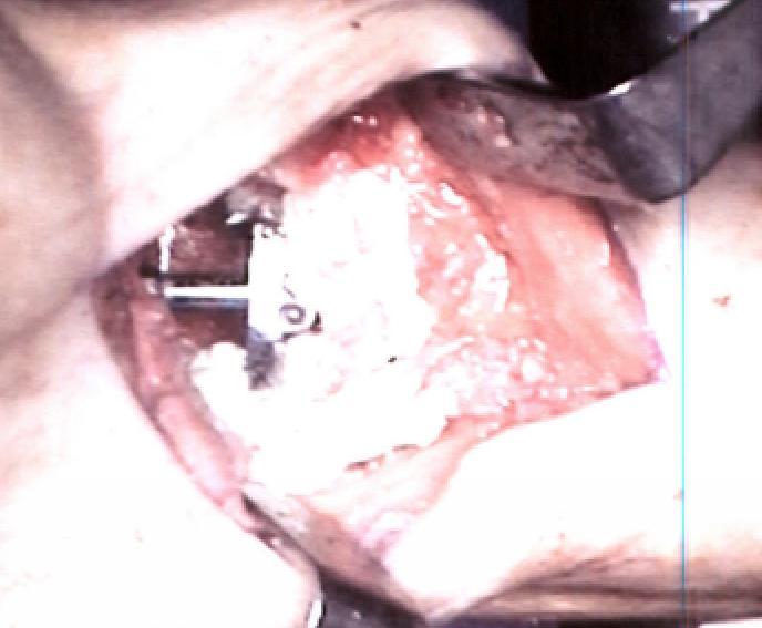 Results Complications: No intraoperative complications requiring additional procedures 1 post-op complication: wound excoriation that resolved with local
