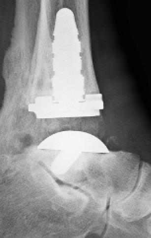 ankle arthrodesis is a viable