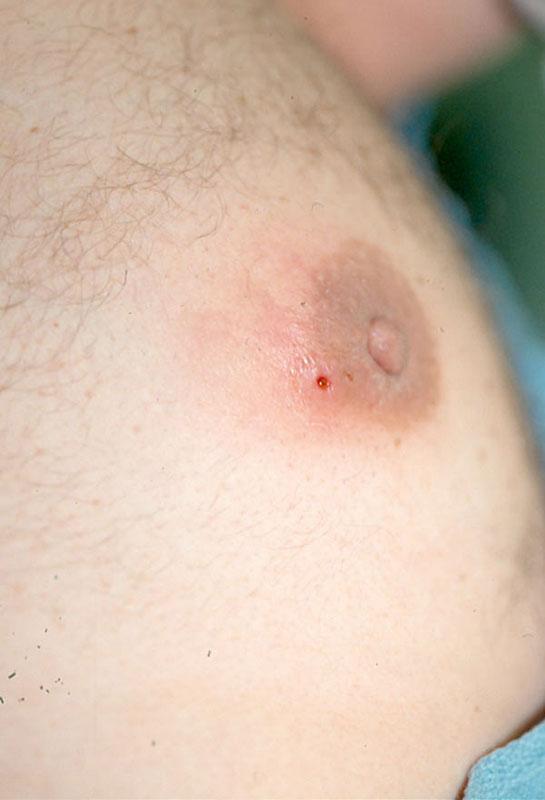 8. A 34-year-old trucker presents with the lesion shown. He says the problem began with an "infection" under the areola about 3 weeks ago.