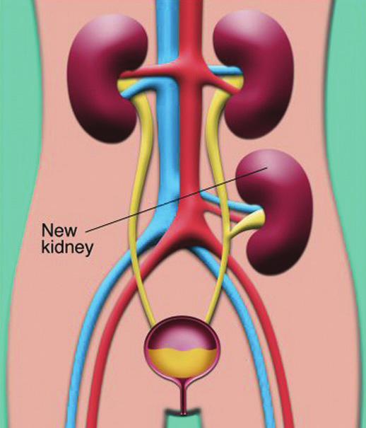 Where is the kidney placed?
