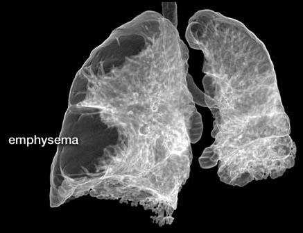 intraluminal gas content pulmonary