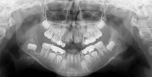 The cemento-enamel junction of the involved tooth is incomplete. -E. The T images show bucco-lingually expanded cortical plates associated with the lesion. F.
