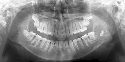 On clinical examination, there was a swelling of the left mandible that was hard to the touch, but the pain and soft tissue swelling, which was the initial chief complaint of the patient, had