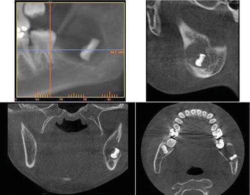 panoramic radiograph revealed a well-defined round unilocular radiolucency surrounding the developing crown of the left lower third molar which had not developed to the cementoenamel junction yet