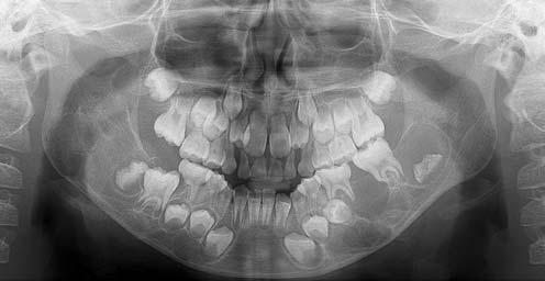 Pericoronal radiolucency associated with incomplete crown there was a moderately painful swelling of the left mandibular angle area.