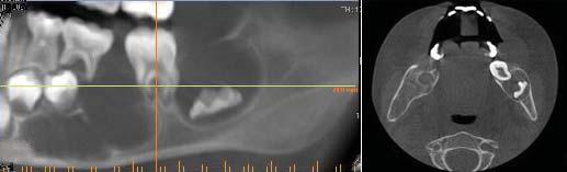 panoramic radiograph revealed a large well-defined round unilocular radiolucency surrounding the developing crown of the lower left third molar, which was displaced upward to the sigmoid notch.