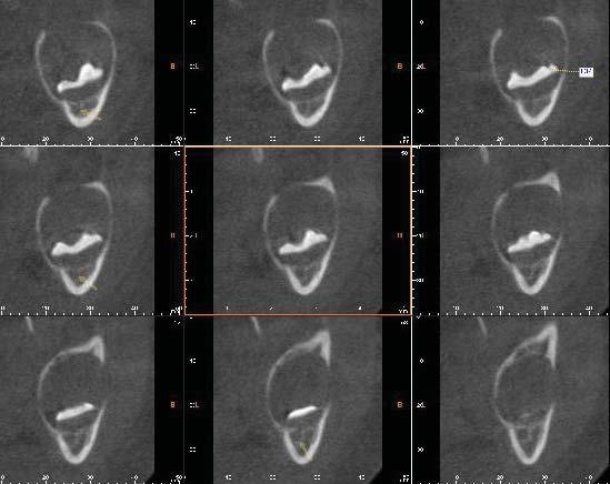 The T images showed a bucco-lingually expanded cortical plate associated with the lesion that surrounded the underdeveloped crown of the left lower third molar.