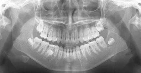 provisional diagnosis of odontogenic keratocyst was made, and the lesion was excised with the extraction of the involved tooth. The histopathological diagnosis proved to be a dentigerous cyst.