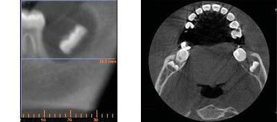 (-) The T images show a well-defined round radiolucency with no cortical expansion surrounding the underdeveloped crown of the lower left third molar.