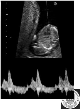 Fetal Cardiac Function 9 wks 14 wks ET ET ICT IVRT IVRT Fetal Cardiac Function-Tei Index p < 0.