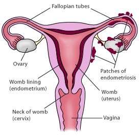 Endometriosis = when endometrial tissue of